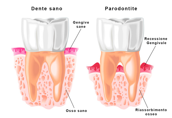 Il protocollo Parodontale